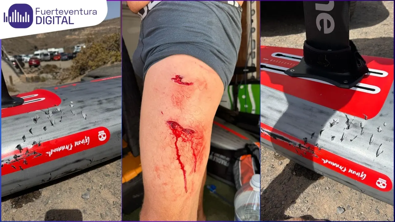 Mordida de un tiburón en Fuerteventura a un folier y a su tabla.