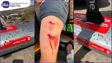 Mordida de un tiburón en Fuerteventura a un folier y a su tabla.